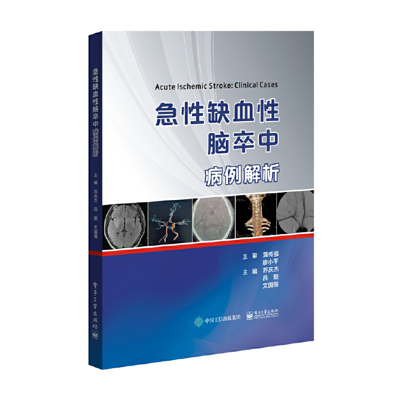 急性缺血性腦卒中病例解析
